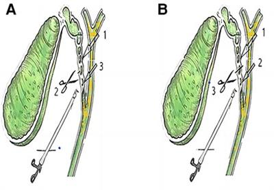 Frontiers | "Semicut” Skill On The Cystic Duct In Laparoscopic ...